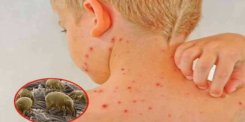 Sv368 Chỉ Cách Diệt Mạt Gà Hiệu Quả Chỉ Trong Một Ngày 3 Mạt gà cắn vào người phải làm thế nào?